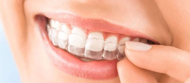 Invisalign: Providing a Seamless Solution for Teeth Misalignment