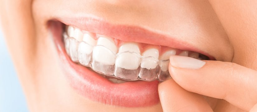 Teeth Misalignment