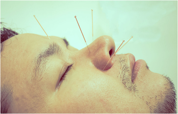 Acupuncture and Allergies: Finding Relief in Florida’s Allergy Season